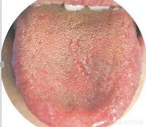 口腔舌头开裂是啥原因:口腔舌头开裂舌头会断吗 舌体有裂纹，是什么原因导致的？