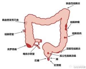 突然拉血便是什么原因:便血有可能是得了什么病？
