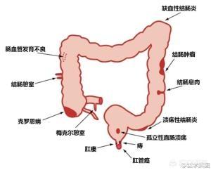 突然拉血便是什么原因:前几天便血，这几天没有了，怎么回事？