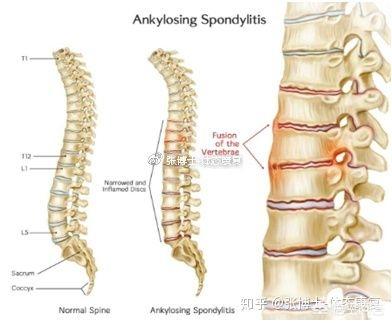 强直性脊柱炎怎么办，确诊强直性脊柱炎怎么办