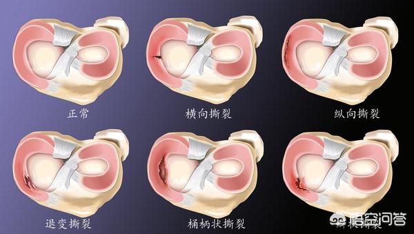 膝盖软骨磨损吃什么号:膝盖半月板损伤，多久可以恢复？吃氨糖有帮助吗？