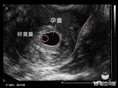 头条问答 怀孕6周 孕囊太小怎么办 19个回答