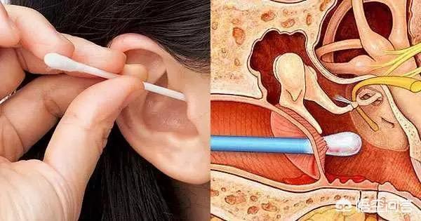 掏耳朵的正确方法，自己掏耳朵会导致中耳炎吗患者日常如何护理