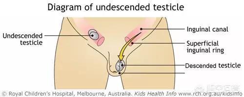 隐睾症:隐睾症能生育吗 刚出生的婴幼儿有隐睾是怎么回事？