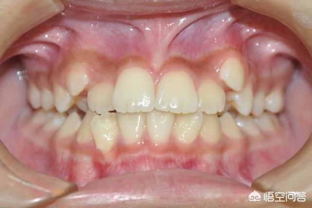 虎牙矫正的最好方法虎牙怎么矫正