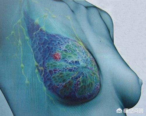 乳腺肿瘤症状有哪些,乳腺肿瘤有13厘米大是晚期吗？