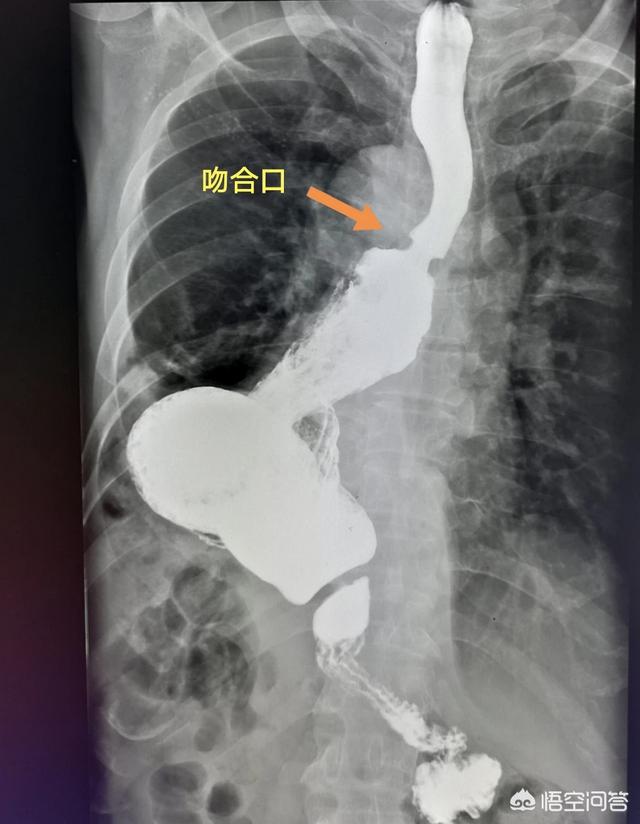 为什么有些癌症病人手术后,死得更快？