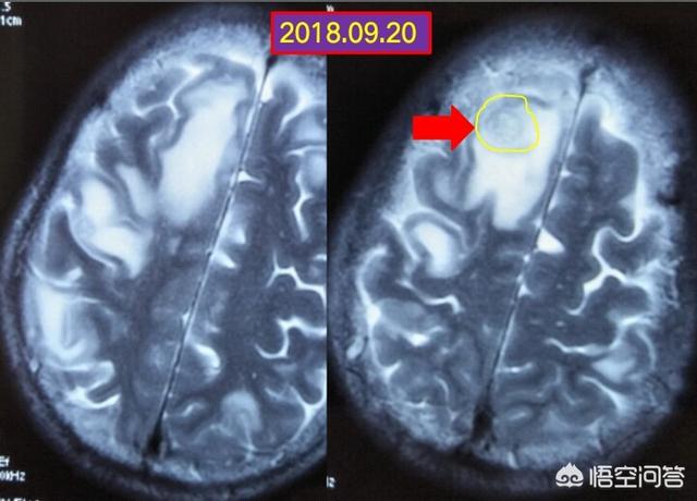 莱姆病症状有什么:莱姆病的症状 耳石症是什么，它有哪些症状？