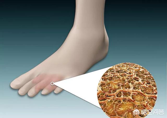 孕妇脚裂怎么办:脚气脚裂需要补充维生素吗？该怎么办？