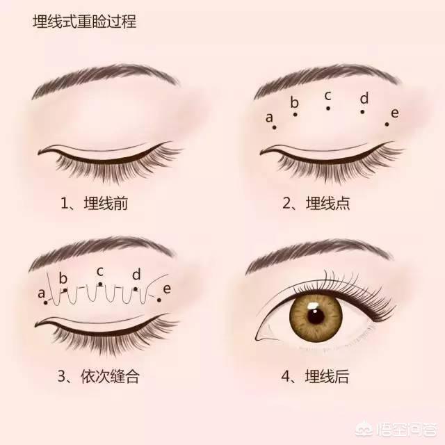 玉镯纳米无痕修复技术,纳米无痕和埋线，有什么不一样？