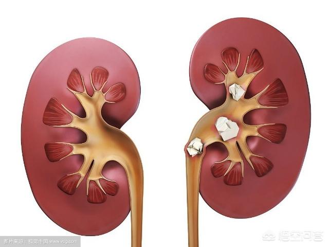 头条问答 - 肾结石能不能喝茶水?(54个回答)