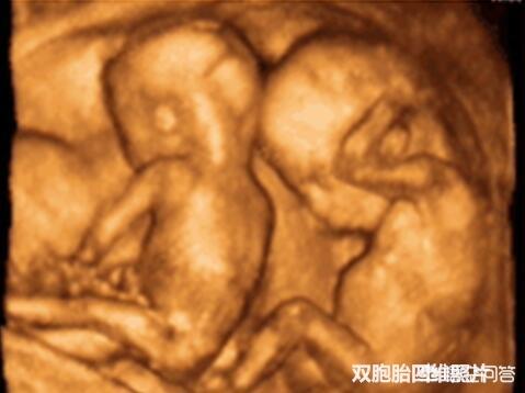 双胞胎一般几周出生属正常？