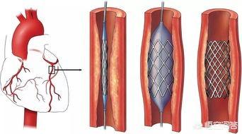 支架手术后注意事项(什么情况下可以安装心脏支架)，做完心脏支架有两个月了，能干活吗？需要注意什么？