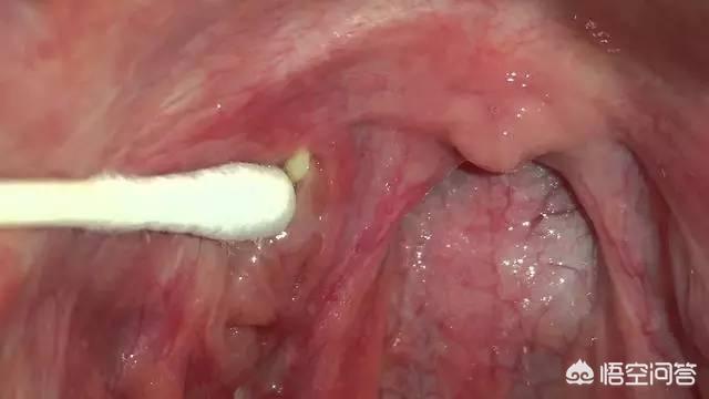 扁桃体有何作用？
