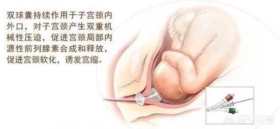 羊妊娠毒血症:孕期真的可以预测到可怕的先兆子痫吗？