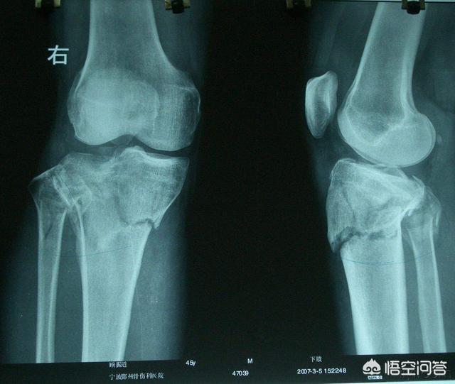 胫骨骨折做了内固定术一年了 走路还是瘸 有什么办法能正常走路吗 头条问答