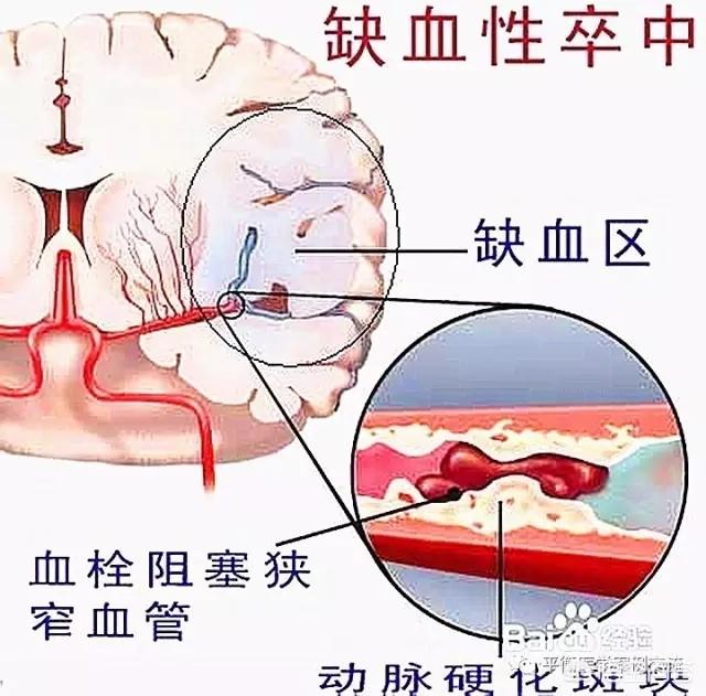 急性脑炎:职工突发急性脑梗，怎么办？