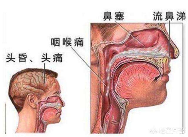 鼻炎有哪些症状:什么是鼻窦炎，有哪些表现？