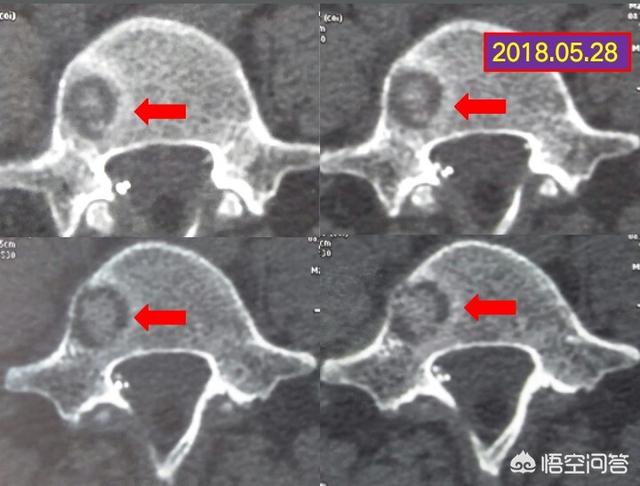 莱姆病症状有什么:莱姆病的症状 耳石症是什么，它有哪些症状？