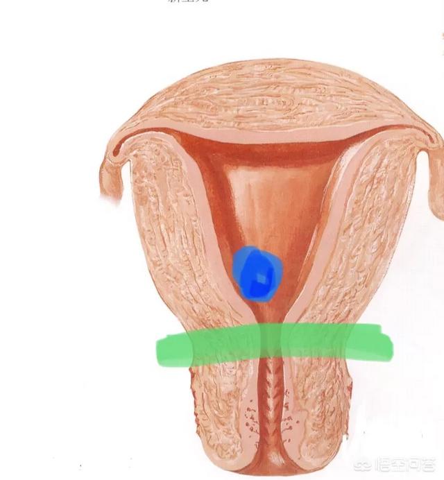 孕囊位于子宫中段影响大不大?孕囊位于宫腔中段在哪个位置