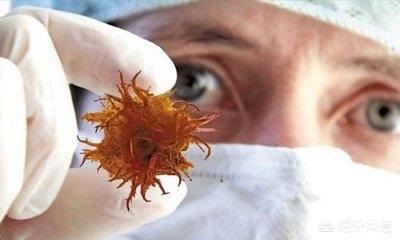 李咏是什么癌:网曝前央视主持人李咏得的是喉癌，怎样才能早点发现喉癌？