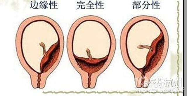 距宫颈内口距离多少要生;宫颈最低点是多少厘米