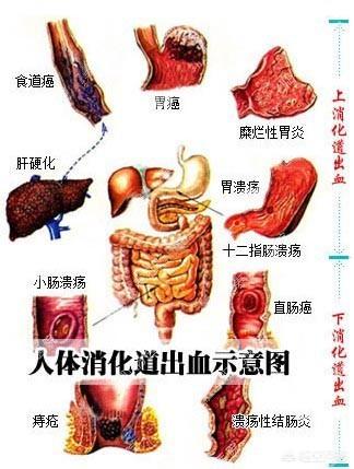 肠道出血:肠道出血 胃出血还是肠出血该如何判定？