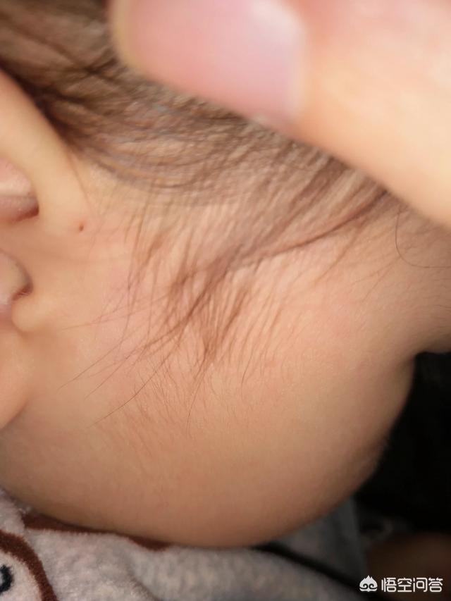 耳朵上有个小眼怎么回事，新生儿耳朵上有个小孔是什么原因