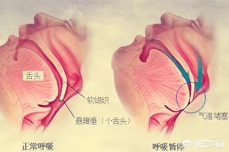 打呼噜偏方(打呼噜偏方一分钟见效)