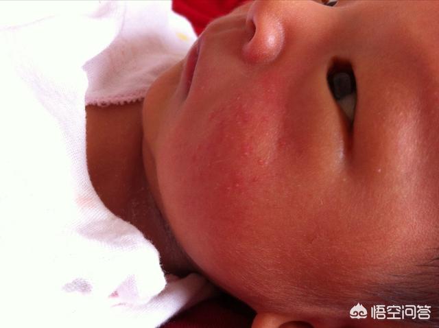 如何正确应对以及预防宝宝湿疹？
