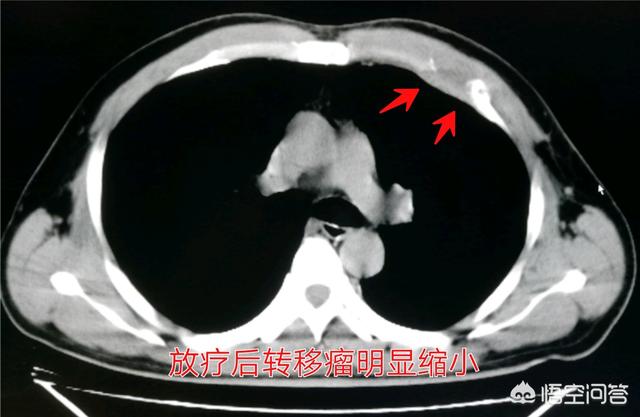 仑伐替尼最新价格,现在的医学技术可以治好肝癌吗？