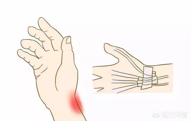 头条问答 - 手腕疼有可能是怎么回事?(7个回答)