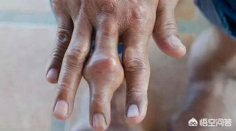 痛風六年，左右手長有痛風石，能夠治愈嗎？