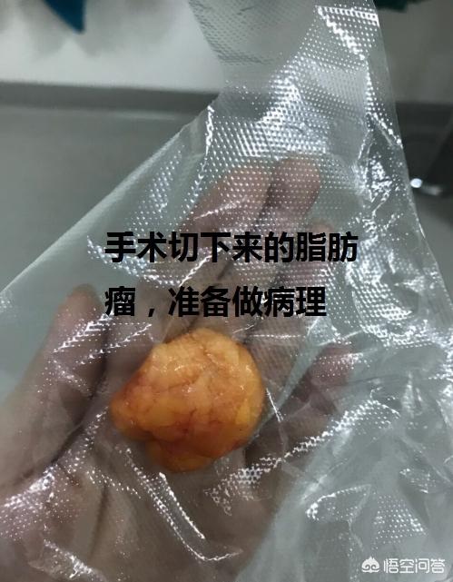 脂肪瘤有什麼好的處理方法麼