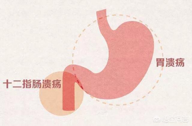 消化道溃疡:得了消化性溃疡，在生活中应该注意些什么？