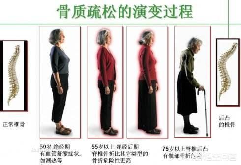 甲状腺机能减退与骨质疏松:艾滋病病人为什么会出现骨质疏松？