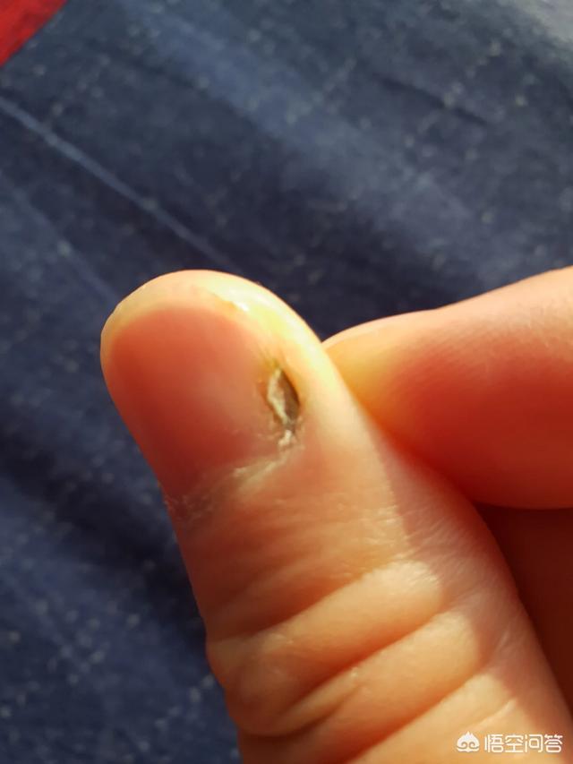 腱鞘囊肿手术后复发,现在越来越硬,好像影响到大拇指甲根部有一脾发
