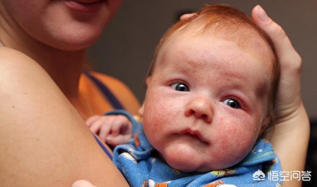 婴儿湿疹，头上和身上起了密密麻麻的小点点，该用什么药？