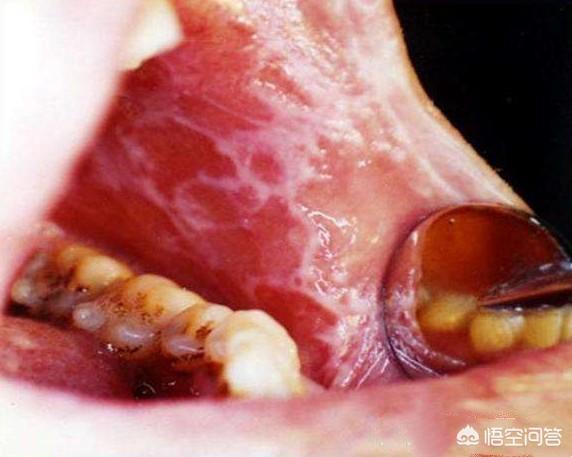 槟榔是目前已经得到世界卫生组织证实的一级致癌物,主要导致口腔癌