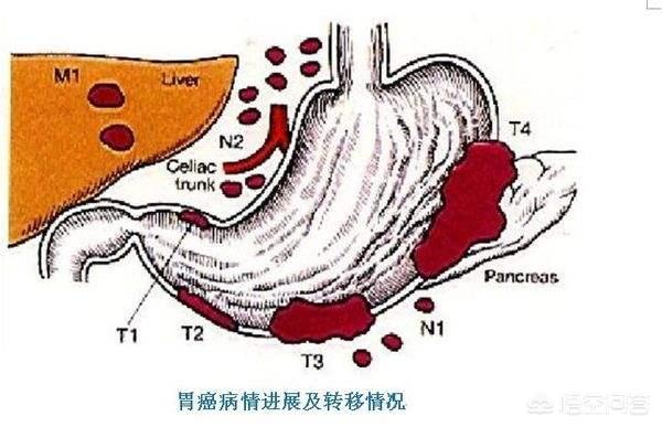 胃癌术后肠梗阻怎么办:胃癌术后小肠梗阻怎么办 胃癌手术后一星期没排便正常吗？