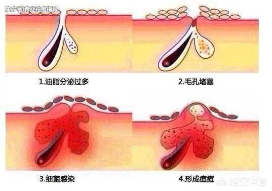 脸上出油长痘怎么办:脸部出油长痘怎么改善