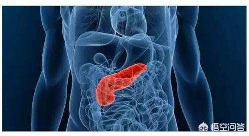 急性胰腺炎的治疗药品:急性胰腺炎的治疗药 胆囊结石引发急性胰腺炎，该怎么治疗？需要切除胆囊吗？