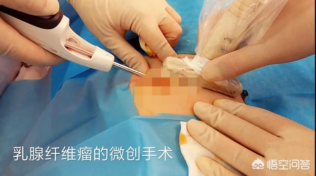 乳腺切除手术:乳腺肿块切除后会再生吗？