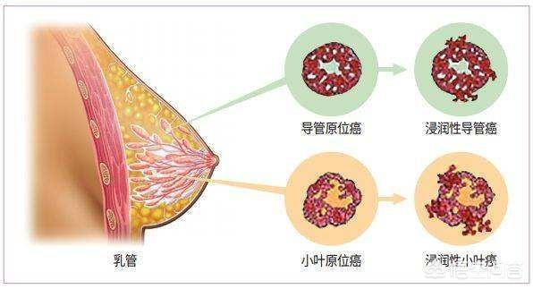 头条问答 浸润性乳腺癌是什么样子的 19个回答