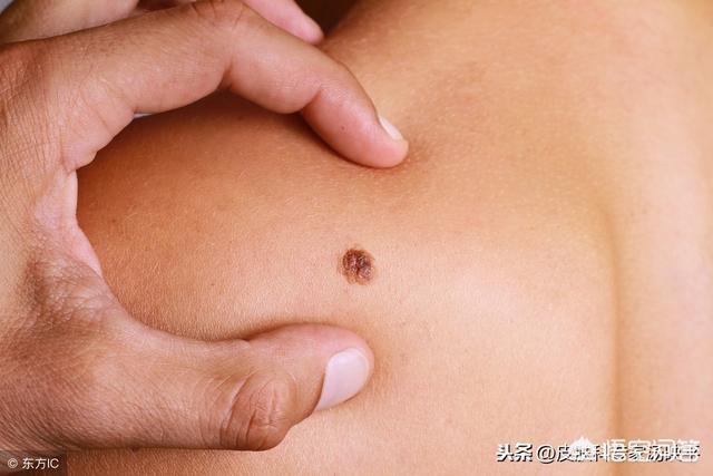 人身上为什么会长痣？哪些痣是危险的提示？