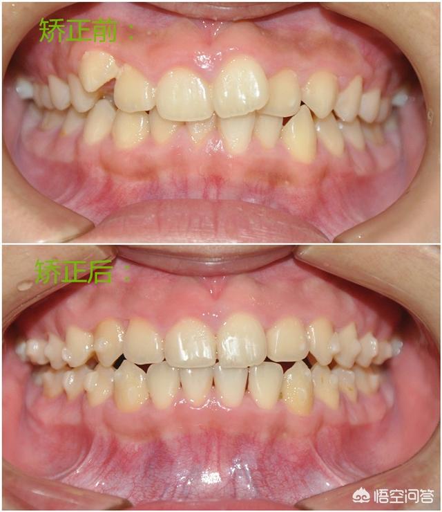 虎牙矫正的最好方法(虎牙怎么矫正)