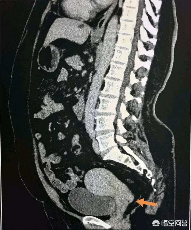 不影响寿命的十大癌症:癌症的最后结果都是死亡吗？有哪些注意事项？