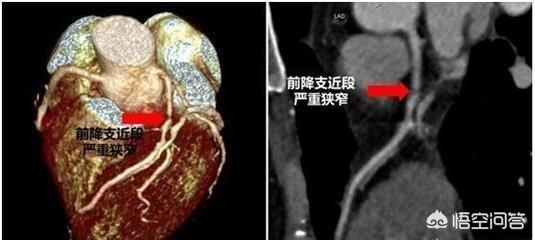 扩张型心肌病概念:紧缩性与扩张性的财政和货币政策，各是什么意思？