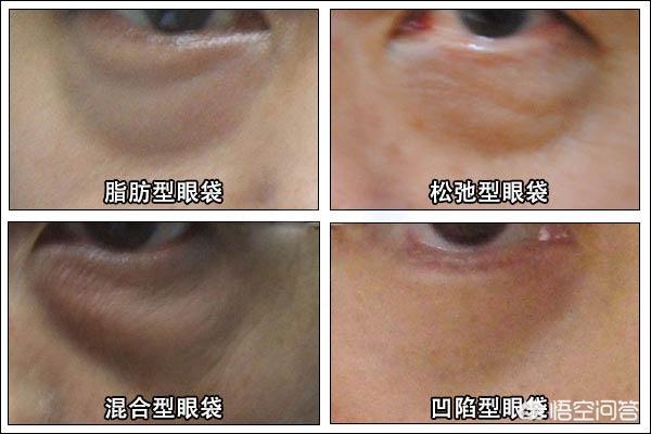 田永成隆鼻:皮肤长斑与肌肤缺水有关吗