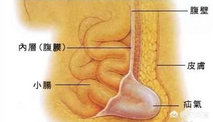 急性腹膜炎:怎么判断自己是否患上了消化性溃疡？